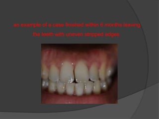 an example of a case finished within 6 months leaving
the teeth with uneven stripped edges.
 