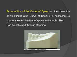 9- correction of the Curve of Spee: for the correction
of an exaggerated Curve of Spee, it is necessary to
create a few millimeters of space in the arch . This
Can be achieved through stripping.
 