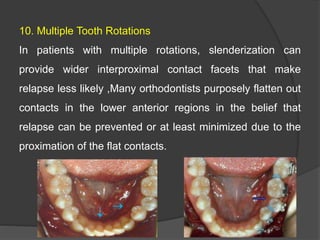 10. Multiple Tooth Rotations
In patients with multiple rotations, slenderization can
provide wider interproximal contact facets that make
relapse less likely ,Many orthodontists purposely flatten out
contacts in the lower anterior regions in the belief that
relapse can be prevented or at least minimized due to the
proximation of the flat contacts.


 