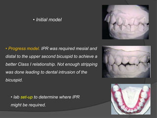 • Initial model
• Progress model. IPR was required mesial and
distal to the upper second bicuspid to achieve a
better Class I relationship. Not enough stripping
was done leading to dental intrusion of the
bicuspid.
• lab set-up to determine where IPR
might be required.
 