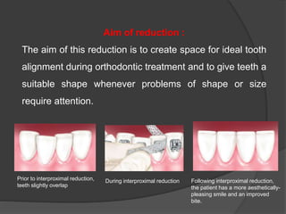 Aim of reduction :
The aim of this reduction is to create space for ideal tooth
alignment during orthodontic treatment and to give teeth a
suitable shape whenever problems of shape or size
require attention.
Prior to interproximal reduction,
teeth slightly overlap
During interproximal reduction Following interproximal reduction,
the patient has a more aesthetically-
pleasing smile and an improved
bite.
 