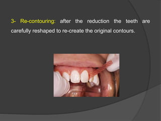 3- Re-contouring: after the reduction the teeth are
carefully reshaped to re-create the original contours.
 