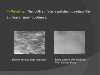 4- Polishing: The tooth surface is polished to reduce the
surface enamel roughness.
Enamel surface after reduction Same surface after polishing
With Sof Lex Discs
 