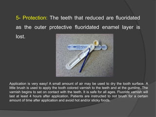 5- Protection: The teeth that reduced are fluoridated
as the outer protective fluoridated enamel layer is
lost.
Application is very easy! A small amount of air may be used to dry the tooth surface. A
little brush is used to apply the tooth colored varnish to the teeth and at the gumline. The
varnish begins to set on contact with the teeth. It is safe for all ages. Fluoride varnish will
last at least 4 hours after application. Patients are instructed to not brush for a certain
amount of time after application and avoid hot and/or sticky foods.
 
