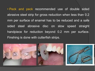 • Peck and peck recommended use of double sided
abrasive steel strip for gross reduction when less than 0.2
mm per surface of enamel has to be reduced and a safe
sided steel abrasive disc on slow speed straight
handpiece for reduction beyond 0.2 mm per surface.
Finshing is done with cutterfish strips.
 