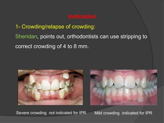 Indication
1- Crowding/relapse of crowding:
Sheridan, points out, orthodontists can use stripping to
correct crowding of 4 to 8 mm.
Severe crowding not indicated for IPR Mild crowding indicated for IPR
 
