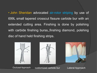 • John Sheridan advocated air-rotor striping by use of
699L small tapered crosscut fissure carbide bur with an
extended cutting area. Finshing is done by polishing
with carbide finshing burss,,finshing diamond, polshing
disc of hand held finshing strips.
Occlusal Approach customized carbide bur Lateral Approach
 