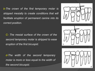 b-The crown of the first temporary molar is
stripped mesially to create conditions that will
facilitate eruption of permanent canine into its
correct position.
C- The mesial surface of the crown of the
second temporary molar is stripped to ease
eruption of the first bicuspid.
d-The width of the second temporary
molar is more or less equal to the width of
the second bicuspid.
 