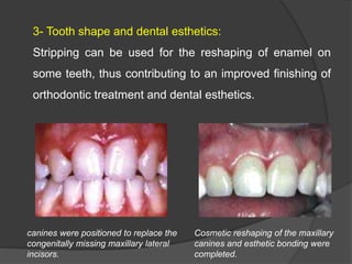 3- Tooth shape and dental esthetics:
Stripping can be used for the reshaping of enamel on
some teeth, thus contributing to an improved finishing of
orthodontic treatment and dental esthetics.
canines were positioned to replace the
congenitally missing maxillary lateral
incisors.
Cosmetic reshaping of the maxillary
canines and esthetic bonding were
completed.
 