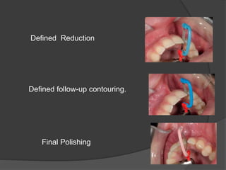 Defined Reduction
Defined follow-up contouring.
Final Polishing
 