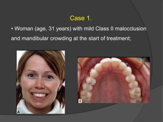 Case 1.
• Woman (age, 31 years) with mild Class II malocclusion
and mandibular crowding at the start of treatment;
 