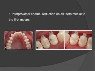 • Interproximal enamel reduction on all teeth mesial to
the first molars.
 