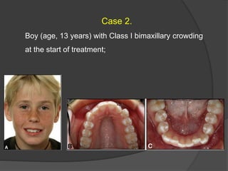 Case 2.
Boy (age, 13 years) with Class I bimaxillary crowding
at the start of treatment;
 