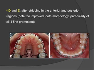 • D and E, after stripping in the anterior and posterior
regions (note the improved tooth morphology, particularly of
all 4 first premolars);
 