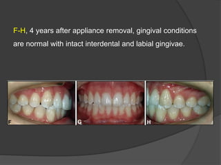 F-H, 4 years after appliance removal, gingival conditions
are normal with intact interdental and labial gingivae.
 