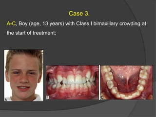 Case 3.
A-C, Boy (age, 13 years) with Class I bimaxillary crowding at
the start of treatment;
 
