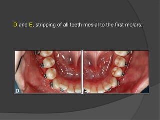 D and E, stripping of all teeth mesial to the first molars;
 