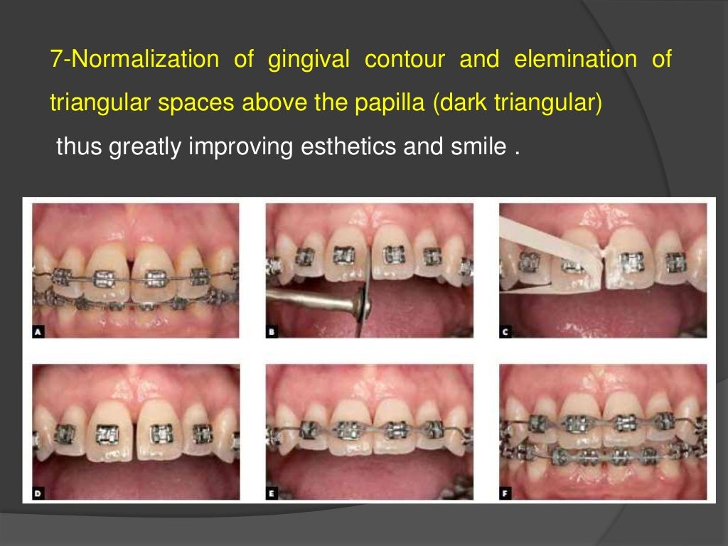 Interproximal Enamel Reduction (stripping)