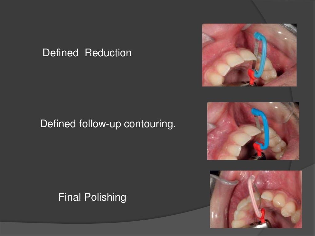 Interproximal Enamel Reduction (stripping)