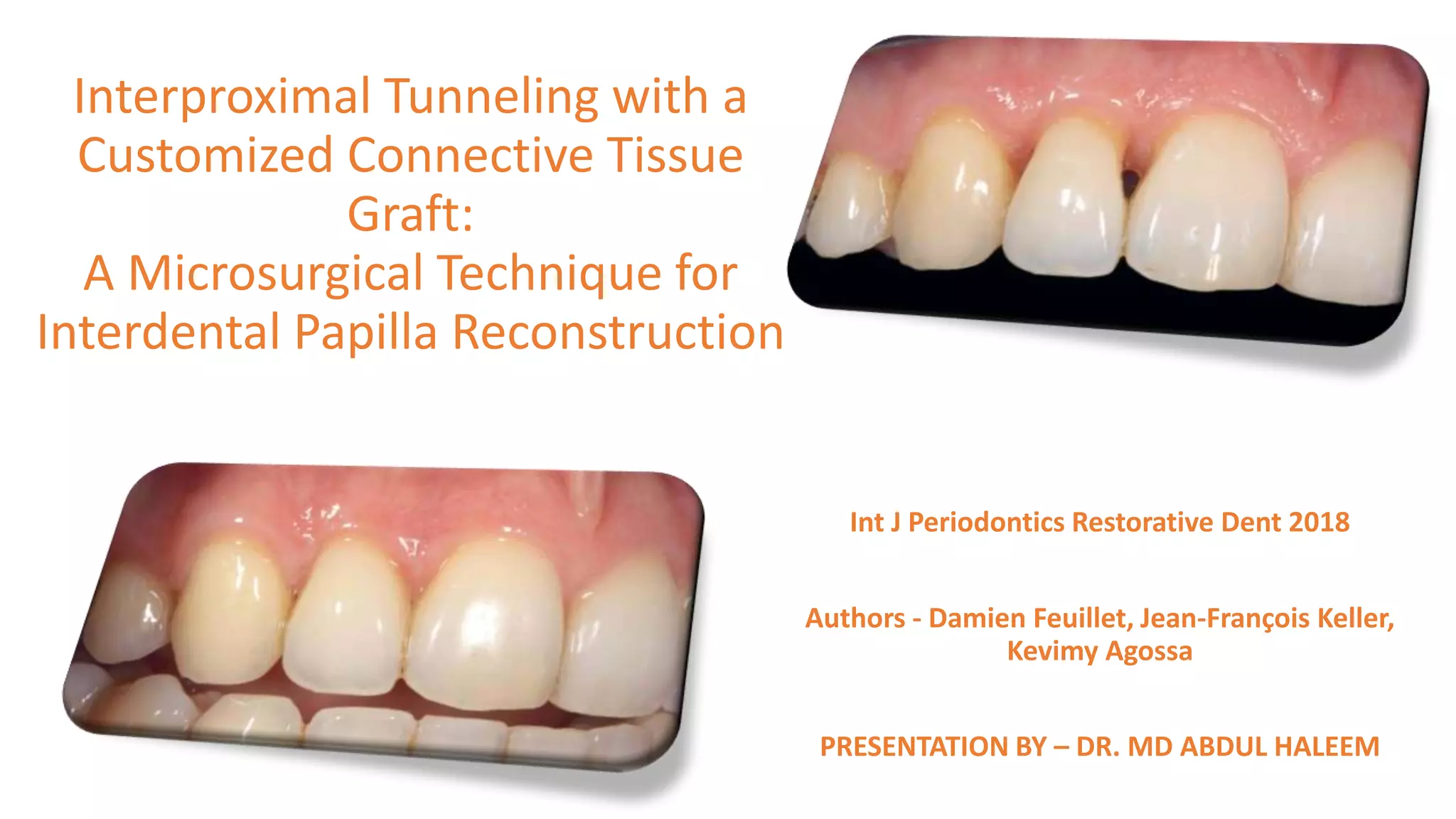 Interproximal tunneling with a customized connective tissue graft
