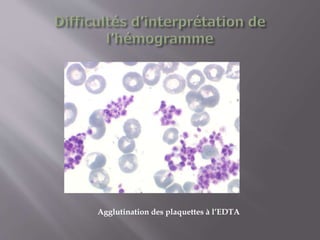 Agglutination des plaquettes à l’EDTA
 