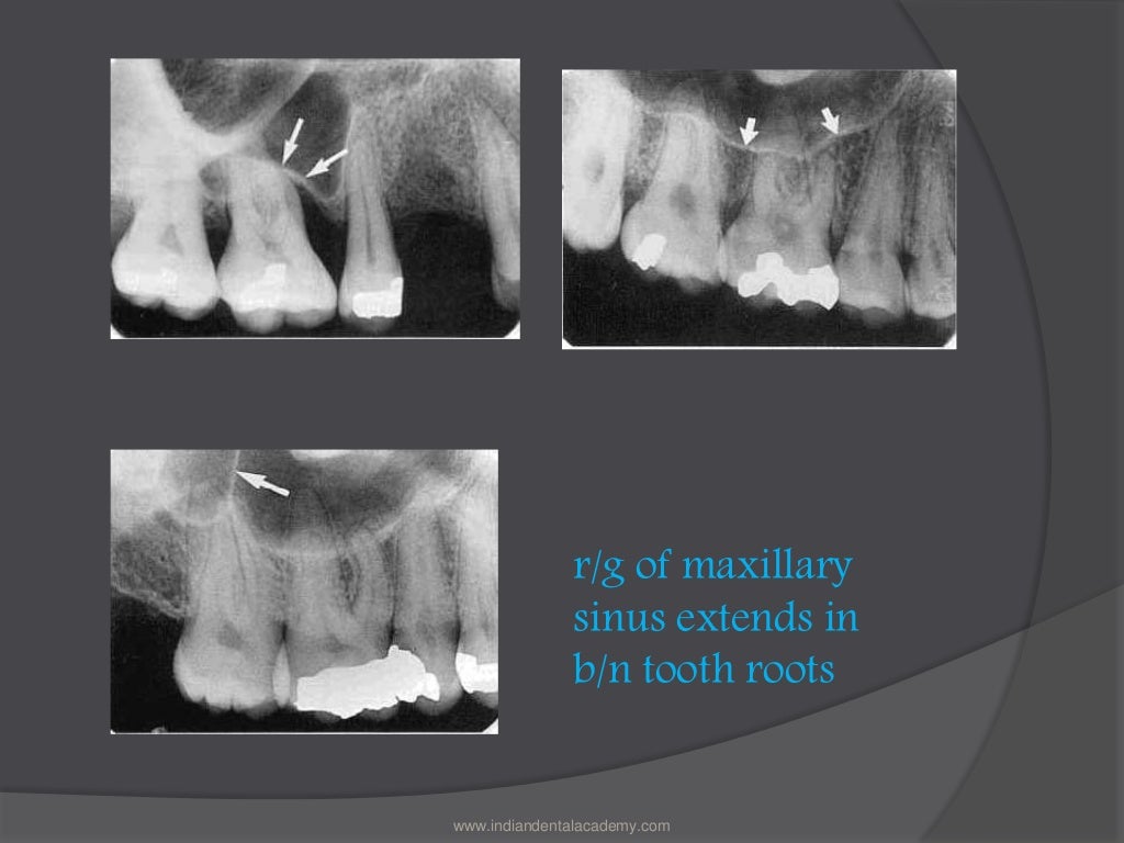 Inter radicular radiolucencies / dental courses
