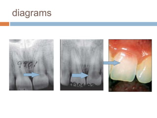 Interrelationship between periodontics and endodontics | PPTX