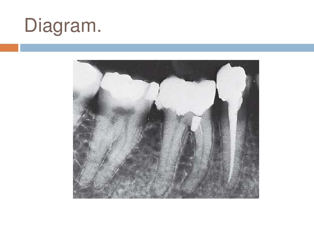 Interrelationship between periodontics and endodontics