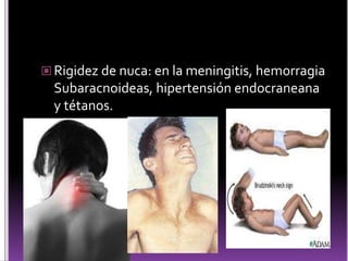  Rigidez de nuca: en la meningitis, hemorragia
Subaracnoideas, hipertensión endocraneana
y tétanos.
 