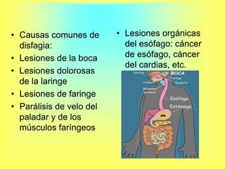 Lesiones orgánicas del esófago: cáncer de esófago, cáncer del cardias, etc.Causas comunes de disfagia:Lesiones de la bocaLesiones dolorosas de la laringeLesiones de faringeParálisis de velo del paladar y de los músculos faríngeos