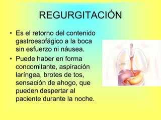REGURGITACIÓNEs el retorno del contenido gastroesofágico a la boca sin esfuerzo ni náusea.Puede haber en forma concomitante, aspiración laríngea, brotes de tos, sensación de ahogo, que pueden despertar al paciente durante la noche.