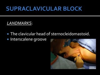 LANDMARKS:
 The clavicular head of sternocleidomastoid.
 Interscalene groove
 