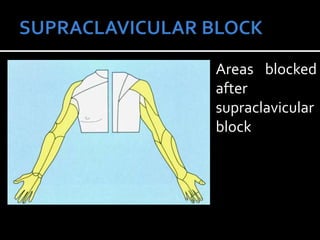 Areas blocked
after
supraclavicular
block
 
