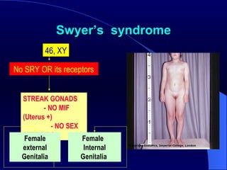 Swyer ’s   syndrome 46, XY No SRY OR its receptors   STREAK GONADS  - NO MIF (Uterus +)  - NO SEX STEROIDS Female  Internal Genitalia  Female external Genitalia 