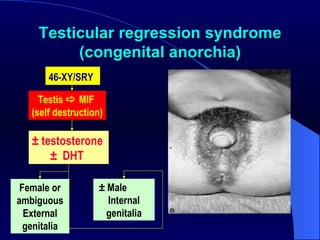 Testicular regression syndrome (congenital anorchia) 46-XY/SRY   Testis    MIF  (self destruction) ± testosterone  ±  DHT   ± Male  Internal genitalia Female or ambiguous External genitalia 