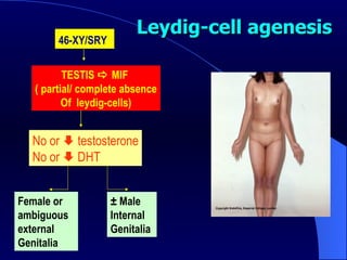 Leydig-cell agenesis 46-XY/SRY   TESTIS    MIF  ( partial/ complete absence Of  leydig-cells) No or    testosterone No or    DHT  ± Male  Internal Genitalia  Female or ambiguous external Genitalia  