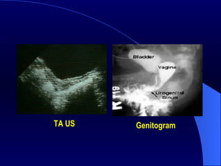 Genitogram  TA US 