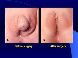 Before surgery   After surgery   