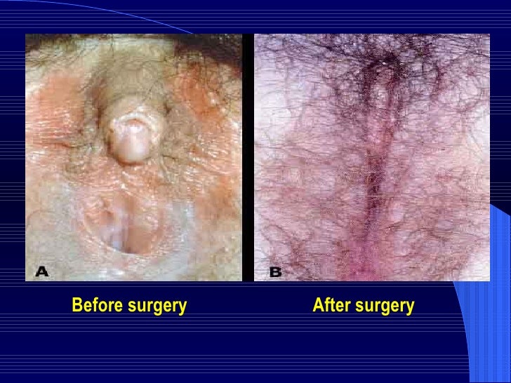 hermaphrodite surgery to choose sex hermaphrodite surgery to choose sex