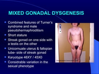 MIXED GONADAL DYSGENESIS Combined features of Turner ’s syndrome and male pseudohermaphroditism  Short stature Streak gonad on one side with a testis on the other Unicornuate uterus & fallopian tube- side of streak gonad  Karyotype 46XY / 45X0 Considrable variation in the sexual phenotype 