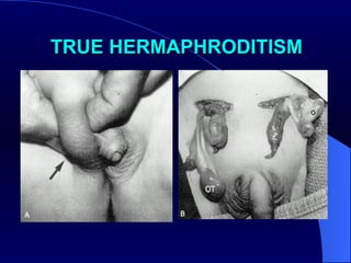 TRUE HERMAPHRODITISM 