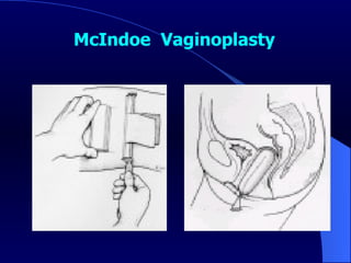 McIndoe  Vaginoplasty 