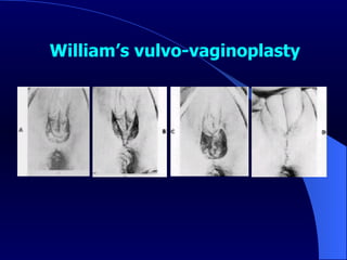 William’s vulvo-vaginoplasty 