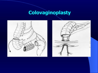 Colovaginoplasty   