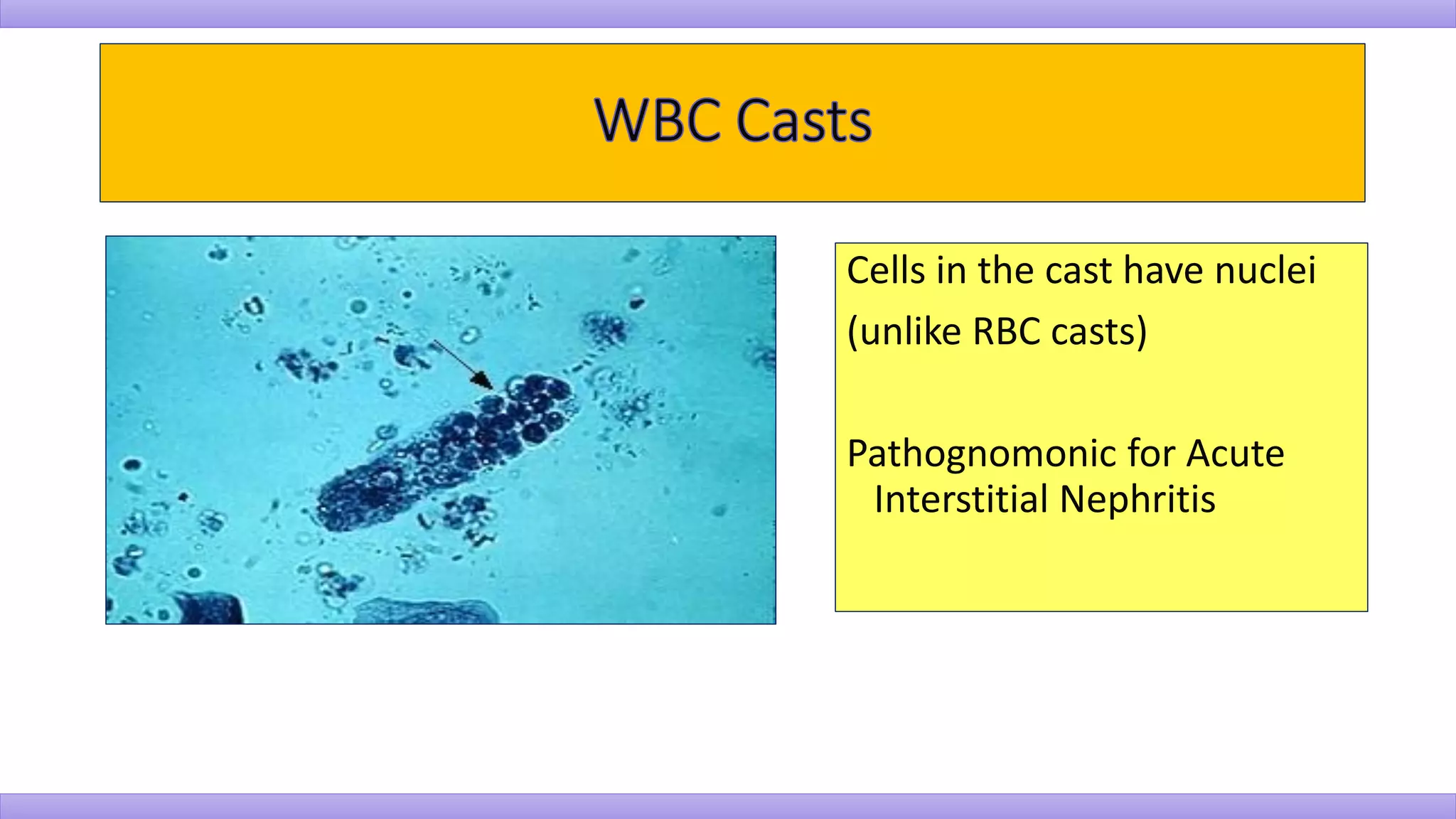 Cells in the cast have nuclei
(unlike RBC casts)
Pathognomonic for Acute
Interstitial Nephritis
 