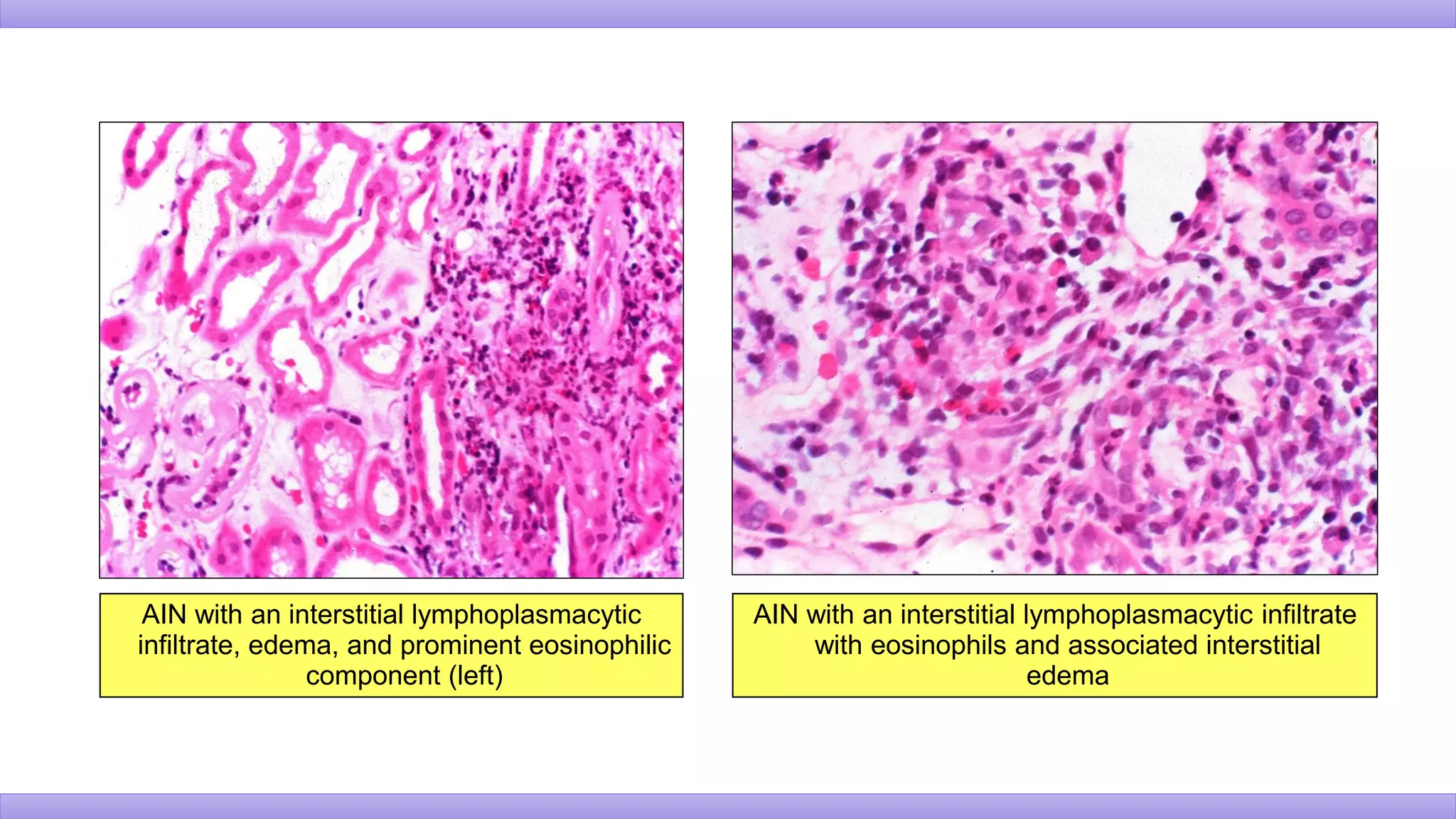 AIN with an interstitial lymphoplasmacytic
infiltrate, edema, and prominent eosinophilic
component (left)
AIN with an interstitial lymphoplasmacytic infiltrate
with eosinophils and associated interstitial
edema
 