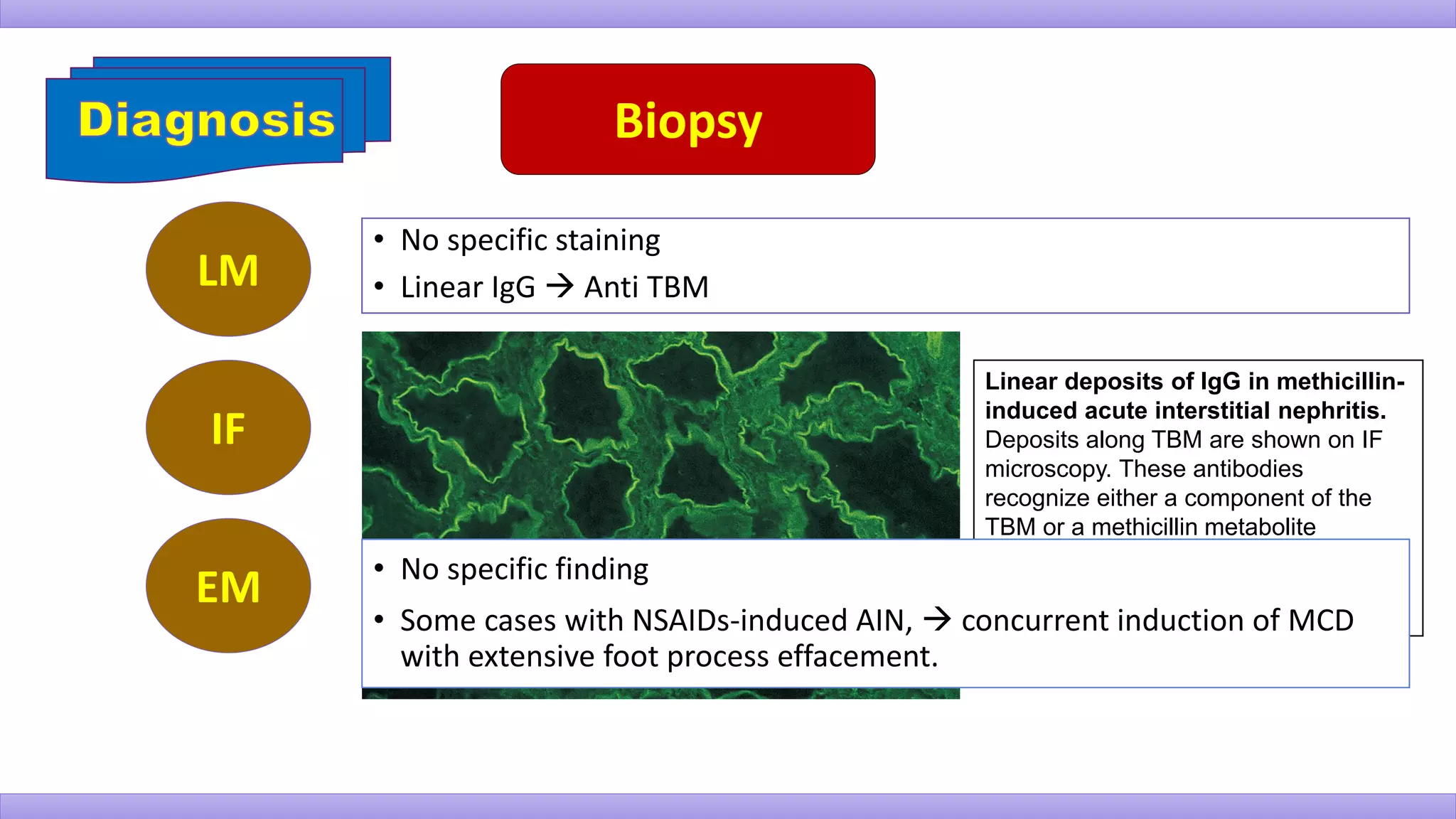 Biopsy
LM
IF
• No specific staining
• Linear IgG  Anti TBM
Linear deposits of IgG in methicillin-
induced acute interstitial nephritis.
Deposits along TBM are shown on IF
microscopy. These antibodies
recognize either a component of the
TBM or a methicillin metabolite
(dimethoxyphenylpenicilloyl) bound to
the TBM. (Courtesy Dr. B Mougenot,
Paris VI University, Paris.)
EM • No specific finding
• Some cases with NSAIDs-induced AIN,  concurrent induction of MCD
with extensive foot process effacement.
 