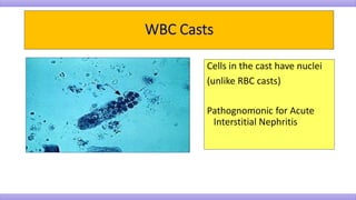 Cells in the cast have nuclei
(unlike RBC casts)
Pathognomonic for Acute
Interstitial Nephritis
 