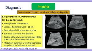 Imaging
Contrib Nephrol. Basel, Karger, 2016, 188; 39–47
Conventional US does not allow a definitive diagnosis.
67y patient had an AKI from NSAIDs
( Cr 1.1 -to 2.8 mg/dl).
• Kidneys were symmetrical.
• Coronal diameters were >11 cm
• Parenchymal thickness was normal
• But renal structure was altered.
• Cortex; diffusely hyperechoic; interstitial
edema & inflammatory infiltrate
• Medullary pyramids were hypoechoic &
irregular, but CMD was preserved
 