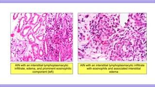 AIN with an interstitial lymphoplasmacytic
infiltrate, edema, and prominent eosinophilic
component (left)
AIN with an interstitial lymphoplasmacytic infiltrate
with eosinophils and associated interstitial
edema
 